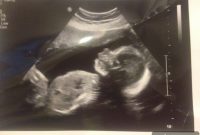 Pregnant with Baby #3 at 24 Weeks: What to Expect Now